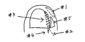 4.根治手術